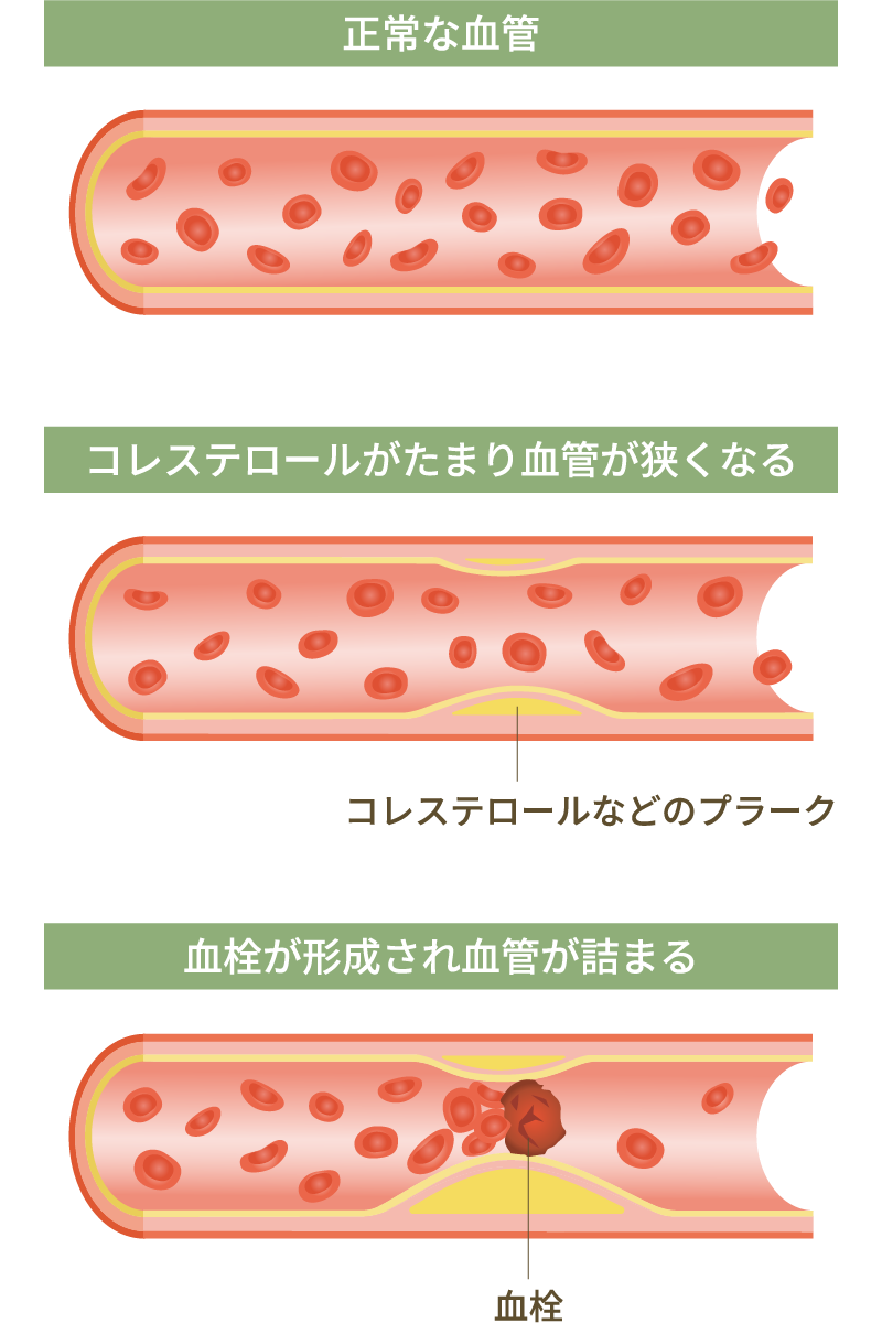 動脈硬化症のイメージ
